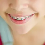 Apparecchio denti per i bambini: consigli e suggerimenti. Riepilogo dei costi